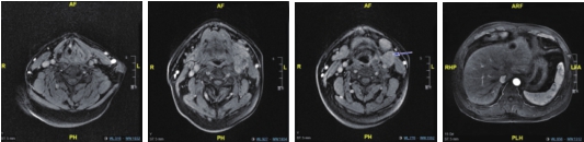 图1 喉MRI、腹部MRI（治疗前）